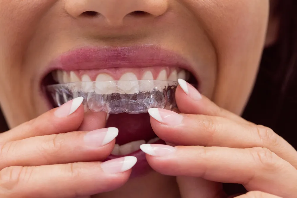 Ortodoncia invisible e Invisalign